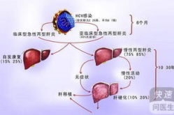 丙肝感染症状,早期症状与晚期危害